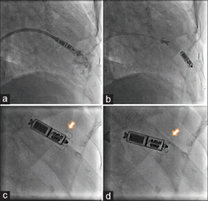 AL FATEBENEFRATELLI. IL PRIMO PACEMAKER BICAMERALE INVISIBILE